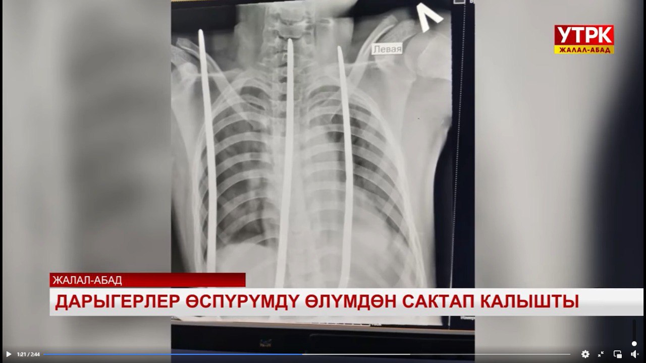 Дарыгерлер айры сайылып калган баланы аман алып калышты